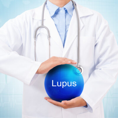 Lupus: Symptoms and Lifestyle Tips
