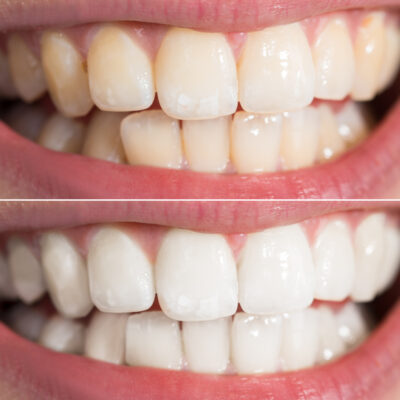 Popular Home Remedies for Teeth Whitening