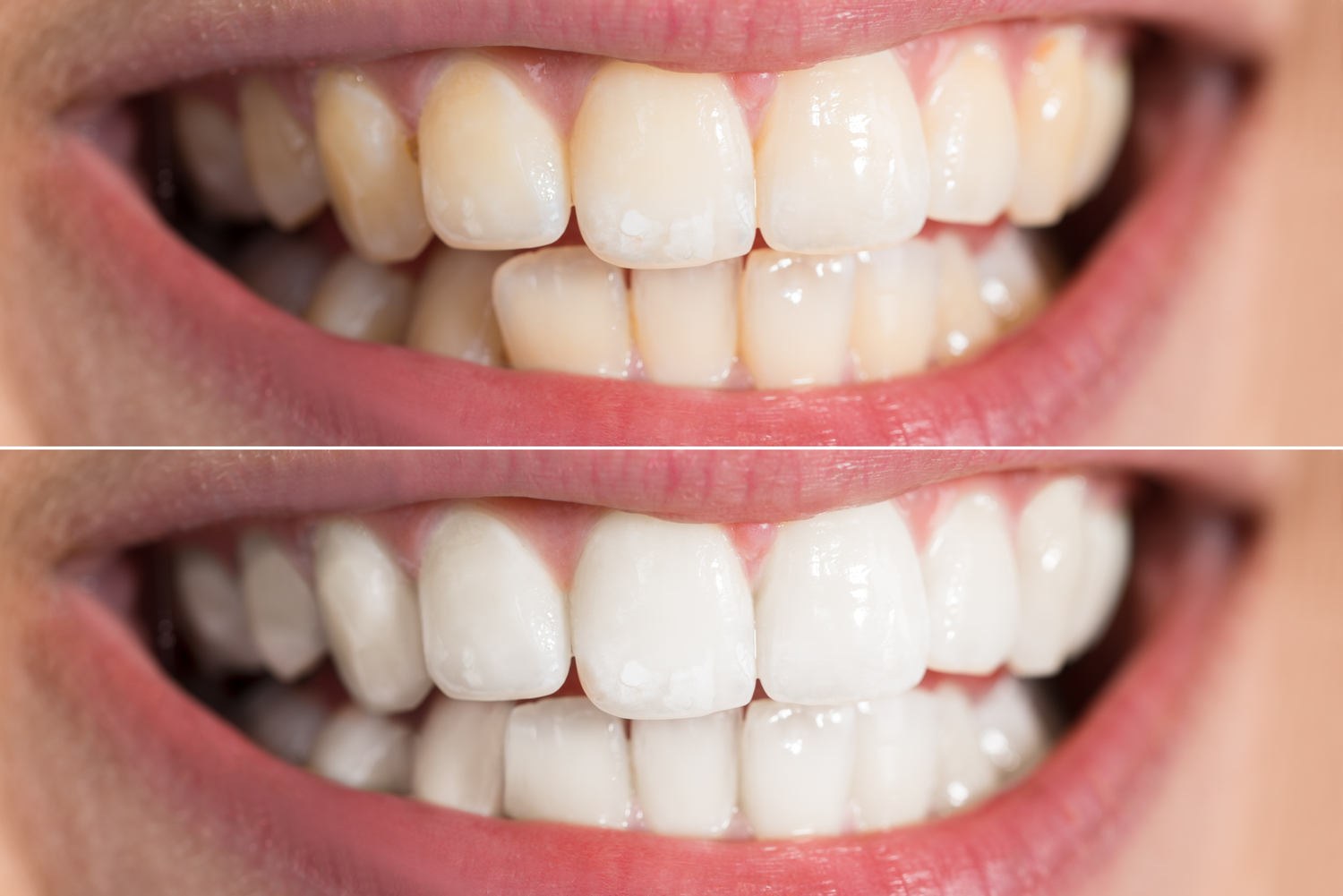 Popular Home Remedies for Teeth Whitening